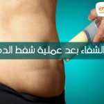 مدة الشفاء بعد عملية شفط الدهون