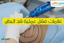 علامات فشل عملية شد البطن