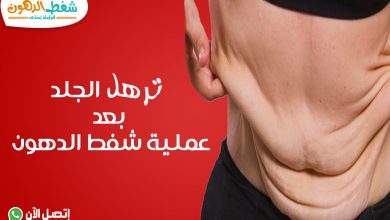 ترهل الجلد بعد عملية شفط الدهون