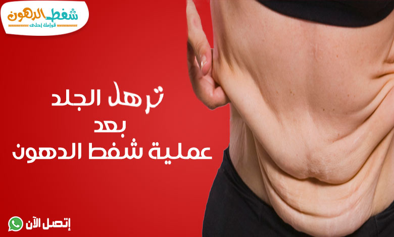 ترهل الجلد بعد عملية شفط الدهون