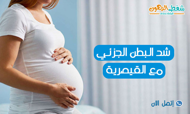 تجربتي مع شد البطن مع الولادة القيصرية