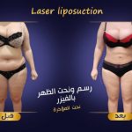 نصائح بعد حقن المؤخرة بالدهون الذاتية